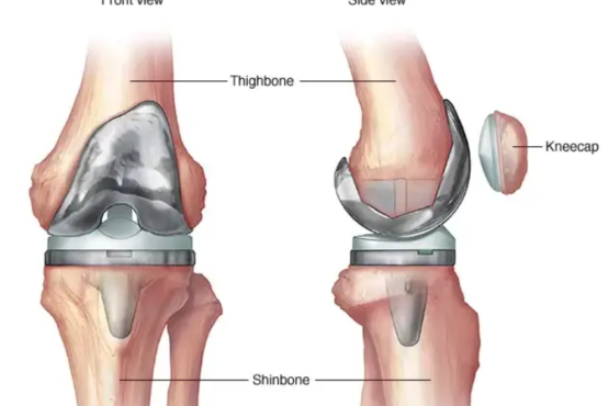 Key Precautions to take after Knee Replacement Surgery