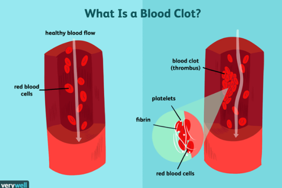 Causes of Blood Clots and Its Symptoms